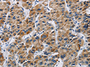 The image on the left is immunohistochemistry of paraffin-embedded Human liver cancer tissue using CSB-PA149561(IFNGR2 Antibody) at dilution 1/40, on the right is treated with synthetic peptide. (Original magnification: ×200)