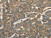 The image on the left is immunohistochemistry of paraffin-embedded Human breast cancer tissue using CSB-PA149571(AIF1 Antibody) at dilution 1/40, on the right is treated with fusion protein. (Original magnification: ×200)