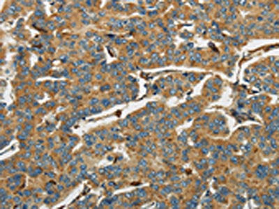 The image on the left is immunohistochemistry of paraffin-embedded Human breast cancer tissue using CSB-PA149571(AIF1 Antibody) at dilution 1/40, on the right is treated with fusion protein. (Original magnification: ×200)