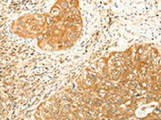 The image on the left is immunohistochemistry of paraffin-embedded Human cervical cancer tissue using CSB-PA149671(RARRES1 Antibody) at dilution 1/60, on the right is treated with synthetic peptide. (Original magnification: ×200)