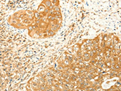 The image on the left is immunohistochemistry of paraffin-embedded Human cervical cancer tissue using CSB-PA149671(RARRES1 Antibody) at dilution 1/60, on the right is treated with synthetic peptide. (Original magnification: ×200)