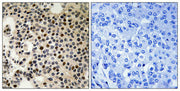 Immunohistochemical analysis of paraffin-embedded human breast carcinoma tissue, using PAK2 (Phospho-Ser197) antibody (left)or the same antibody preincubated with blocking peptide (right).