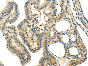 The image on the left is immunohistochemistry of paraffin-embedded Human thyroid cancer tissue using CSB-PA149991(CHGA Antibody) at dilution 1/35, on the right is treated with synthetic peptide. (Original magnification: ×200)