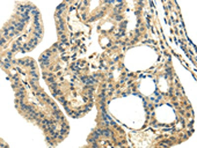 The image on the left is immunohistochemistry of paraffin-embedded Human thyroid cancer tissue using CSB-PA149991(CHGA Antibody) at dilution 1/35, on the right is treated with synthetic peptide. (Original magnification: ×200)