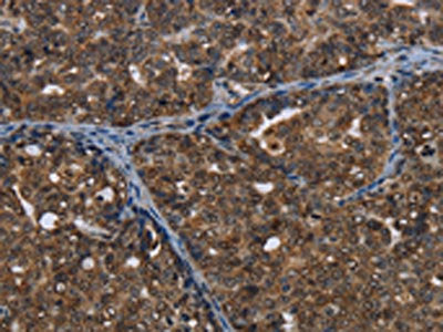The image on the left is immunohistochemistry of paraffin-embedded Human ovarian cancer tissue using CSB-PA150016(CERS6 Antibody) at dilution 1/35, on the right is treated with synthetic peptide. (Original magnification: ×200)