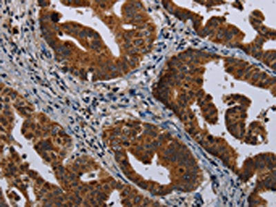 The image on the left is immunohistochemistry of paraffin-embedded Human gastic cancer tissue using CSB-PA150250(MAGEB3 Antibody) at dilution 1/20, on the right is treated with synthetic peptide. (Original magnification: ×200)