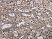 The image on the left is immunohistochemistry of paraffin-embedded Human thyroid cancer tissue using CSB-PA150642(NAA25 Antibody) at dilution 1/40, on the right is treated with synthetic peptide. (Original magnification: ×200)