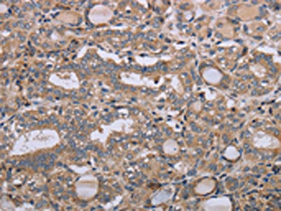 The image on the left is immunohistochemistry of paraffin-embedded Human thyroid cancer tissue using CSB-PA150642(NAA25 Antibody) at dilution 1/40, on the right is treated with synthetic peptide. (Original magnification: ×200)