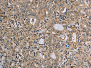 The image on the left is immunohistochemistry of paraffin-embedded Human thyroid cancer tissue using CSB-PA150668(RAB39B Antibody) at dilution 1/45, on the right is treated with synthetic peptide. (Original magnification: ×200)