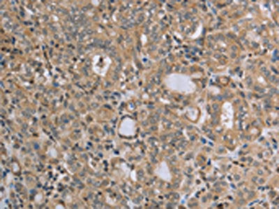 The image on the left is immunohistochemistry of paraffin-embedded Human thyroid cancer tissue using CSB-PA150668(RAB39B Antibody) at dilution 1/45, on the right is treated with synthetic peptide. (Original magnification: ×200)