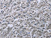 The image on the left is immunohistochemistry of paraffin-embedded Human liver cancer tissue using CSB-PA150749(FES Antibody) at dilution 1/35, on the right is treated with fusion protein. (Original magnification: ×200)
