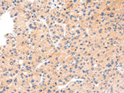 The image on the left is immunohistochemistry of paraffin-embedded Human liver cancer tissue using CSB-PA150824(IKZF4 Antibody) at dilution 1/20, on the right is treated with synthetic peptide. (Original magnification: ×200)