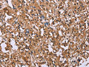 The image on the left is immunohistochemistry of paraffin-embedded Human thyroid cancer tissue using CSB-PA151107(FGFR2 Antibody) at dilution 1/20, on the right is treated with synthetic peptide. (Original magnification: ×200)
