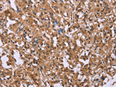 The image on the left is immunohistochemistry of paraffin-embedded Human thyroid cancer tissue using CSB-PA151107(FGFR2 Antibody) at dilution 1/20, on the right is treated with synthetic peptide. (Original magnification: ×200)