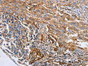The image on the left is immunohistochemistry of paraffin-embedded Human liver cancer tissue using CSB-PA151172(CD151 Antibody) at dilution 1/10, on the right is treated with fusion protein. (Original magnification: ×200)