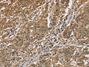 The image is immunohistochemistry of paraffin-embedded Human gastic cancer tissue using CSB-PA151289(CKMT2 Antibody) at dilution 1/60. (Original magnification: ×200)