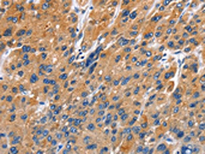 The image on the left is immunohistochemistry of paraffin-embedded Human liver cancer tissue using CSB-PA151323(EDN3 Antibody) at dilution 1/40, on the right is treated with fusion protein. (Original magnification: ×200)