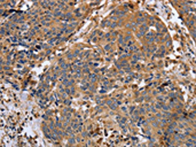 The image on the left is immunohistochemistry of paraffin-embedded Human cervical cancer tissue using CSB-PA151401(MMP9 Antibody) at dilution 1/20, on the right is treated with synthetic peptide. (Original magnification: ×200)