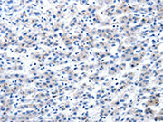 The image on the left is immunohistochemistry of paraffin-embedded Human liver cancer tissue using CSB-PA151818(AIMP2 Antibody) at dilution 1/25, on the right is treated with fusion protein. (Original magnification: ×200)