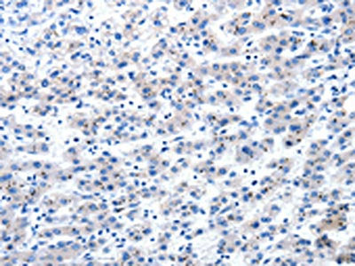 The image on the left is immunohistochemistry of paraffin-embedded Human liver cancer tissue using CSB-PA151818(AIMP2 Antibody) at dilution 1/25, on the right is treated with fusion protein. (Original magnification: ×200)