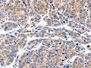 The image on the left is immunohistochemistry of paraffin-embedded Human liver cancer tissue using CSB-PA151831(MYL9 Antibody) at dilution 1/80, on the right is treated with synthetic peptide. (Original magnification: ×200)