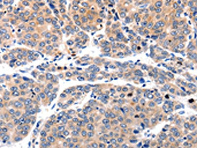 The image on the left is immunohistochemistry of paraffin-embedded Human liver cancer tissue using CSB-PA151831(MYL9 Antibody) at dilution 1/80, on the right is treated with synthetic peptide. (Original magnification: ×200)
