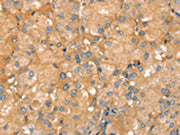 The image on the left is immunohistochemistry of paraffin-embedded Human liver cancer tissue using CSB-PA151893(SLC41A2 Antibody) at dilution 1/20, on the right is treated with synthetic peptide. (Original magnification: ×200)