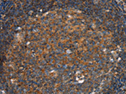 The image on the left is immunohistochemistry of paraffin-embedded Human tonsil tissue using CSB-PA152057(PFKL Antibody) at dilution 1/25, on the right is treated with fusion protein. (Original magnification: ×200)