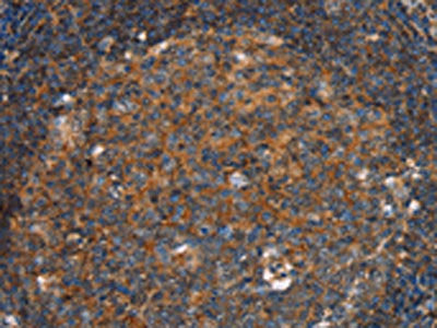 The image on the left is immunohistochemistry of paraffin-embedded Human tonsil tissue using CSB-PA152057(PFKL Antibody) at dilution 1/25, on the right is treated with fusion protein. (Original magnification: ×200)
