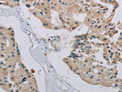 The image on the left is immunohistochemistry of paraffin-embedded Human prostate cancer tissue using CSB-PA152383(PHKA2 Antibody) at dilution 1/30, on the right is treated with synthetic peptide. (Original magnification: ×200)