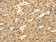 The image on the left is immunohistochemistry of paraffin-embedded Human liver cancer tissue using CSB-PA152384(SAMD7 Antibody) at dilution 1/35, on the right is treated with fusion protein. (Original magnification: ×200)