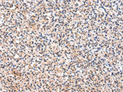 The image on the left is immunohistochemistry of paraffin-embedded Human prostate cancer tissue using CSB-PA152490(FGF6 Antibody) at dilution 1/30, on the right is treated with synthetic peptide. (Original magnification: ×200)