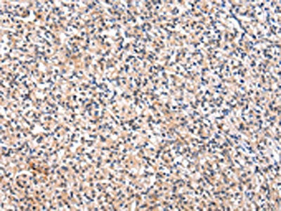 The image on the left is immunohistochemistry of paraffin-embedded Human prostate cancer tissue using CSB-PA152490(FGF6 Antibody) at dilution 1/30, on the right is treated with synthetic peptide. (Original magnification: ×200)