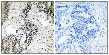 Immunohistochemical analysis of paraffin-embedded human colon carcinoma tissue using CDC25C (Phospho-Ser198) antibody (left)or the same antibody preincubated with blocking peptide (right).