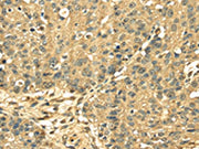 The image on the left is immunohistochemistry of paraffin-embedded Human breast cancer tissue using CSB-PA152933(RPS3 Antibody) at dilution 1/25, on the right is treated with fusion protein. (Original magnification: ×200)