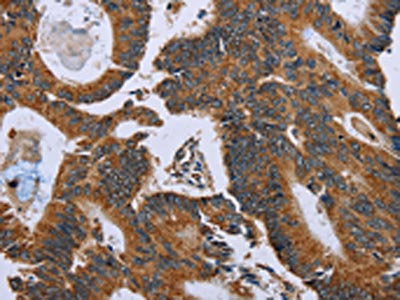 The image on the left is immunohistochemistry of paraffin-embedded Human colon cancer tissue using CSB-PA153165(GH2 Antibody) at dilution 1/60, on the right is treated with fusion protein. (Original magnification: ×200)