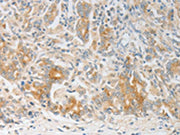 The image on the left is immunohistochemistry of paraffin-embedded Human gastic cancer tissue using CSB-PA153268(CALCR Antibody) at dilution 1/20, on the right is treated with fusion protein. (Original magnification: ×200)