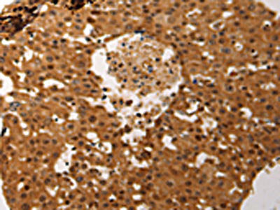 The image on the left is immunohistochemistry of paraffin-embedded Human ovarian cancer tissue using CSB-PA153426(JUND Antibody) at dilution 1/60, on the right is treated with synthetic peptide. (Original magnification: ×200)