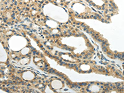The image on the left is immunohistochemistry of paraffin-embedded Human thyroid cancer tissue using CSB-PA153500(SMYD2 Antibody) at dilution 1/30, on the right is treated with synthetic peptide. (Original magnification: ×200)