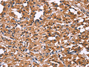 The image on the left is immunohistochemistry of paraffin-embedded Human thyroid cancer tissue using CSB-PA153505(DKK4 Antibody) at dilution 1/20, on the right is treated with fusion protein. (Original magnification: ×200)