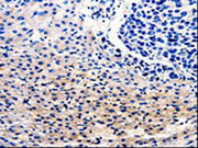The image on the left is immunohistochemistry of paraffin-embedded Human liver cancer tissue using CSB-PA153558(CDC20 Antibody) at dilution 1/25, on the right is treated with fusion protein. (Original magnification: ×200)