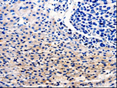 The image on the left is immunohistochemistry of paraffin-embedded Human liver cancer tissue using CSB-PA153558(CDC20 Antibody) at dilution 1/25, on the right is treated with fusion protein. (Original magnification: ×200)