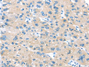 The image on the left is immunohistochemistry of paraffin-embedded Human liver cancer tissue using CSB-PA153577(IGFBP3 Antibody) at dilution 1/45, on the right is treated with synthetic peptide. (Original magnification: ×200)
