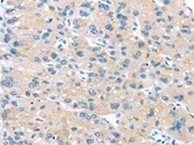 The image on the left is immunohistochemistry of paraffin-embedded Human liver cancer tissue using CSB-PA153577(IGFBP3 Antibody) at dilution 1/45, on the right is treated with synthetic peptide. (Original magnification: ×200)
