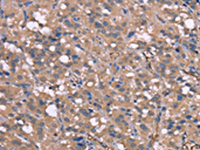 The image on the left is immunohistochemistry of paraffin-embedded Human thyroid cancer tissue using CSB-PA153691(HP Antibody) at dilution 1/50, on the right is treated with synthetic peptide. (Original magnification: ×200)