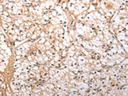 The image on the left is immunohistochemistry of paraffin-embedded Human renal cancer tissue using CSB-PA153820(HCRTR1 Antibody) at dilution 1/100, on the right is treated with synthetic peptide. (Original magnification: ×200)