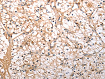 The image on the left is immunohistochemistry of paraffin-embedded Human renal cancer tissue using CSB-PA153820(HCRTR1 Antibody) at dilution 1/100, on the right is treated with synthetic peptide. (Original magnification: ×200)