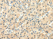 The image on the left is immunohistochemistry of paraffin-embedded Human liver cancer tissue using CSB-PA153836(CHGA Antibody) at dilution 1/20, on the right is treated with synthetic peptide. (Original magnification: ×200)