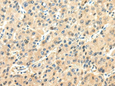 The image on the left is immunohistochemistry of paraffin-embedded Human liver cancer tissue using CSB-PA153836(CHGA Antibody) at dilution 1/20, on the right is treated with synthetic peptide. (Original magnification: ×200)