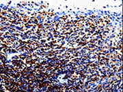 The image on the left is immunohistochemistry of paraffin-embedded Human tosil tissue using CSB-PA153938(IL10RA Antibody) at dilution 1/60, on the right is treated with fusion protein. (Original magnification: ×200)